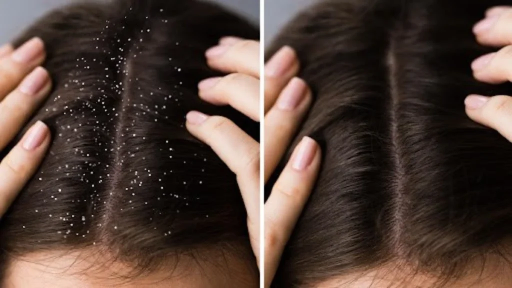 Dandruff Treatment