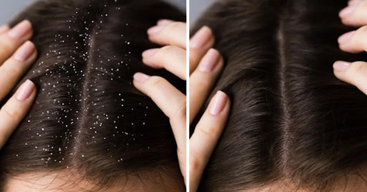 Dandruff Treatment