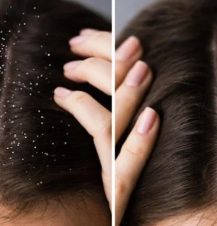 Dandruff Treatment