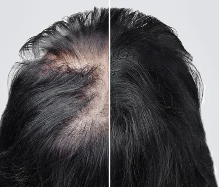 HAIR LOSS TREATMENT