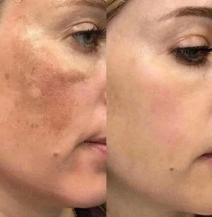 PIGMENTATION TREATMENT