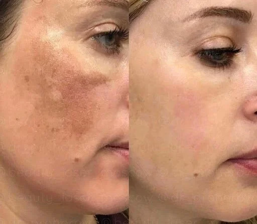 PIGMENTATION TREATMENT