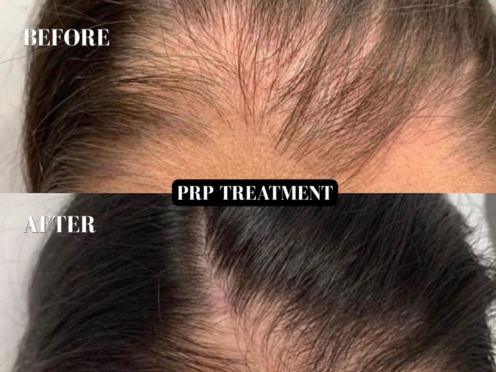 PRP Treatment for Hair & Face – The Ultimate Guide to Natural Rejuvenation