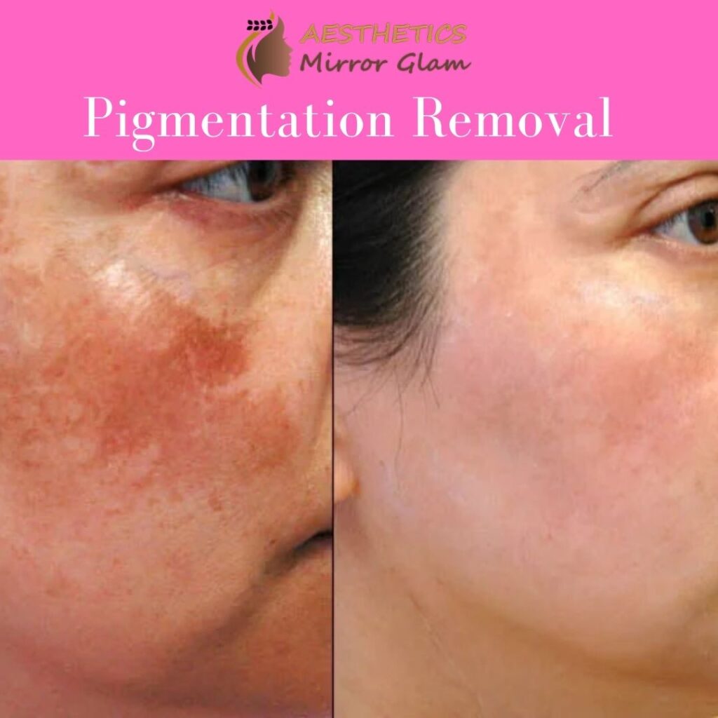 pigmentation-removal-near-me-pigmentation-removal-in-rohini-delhi.jpg