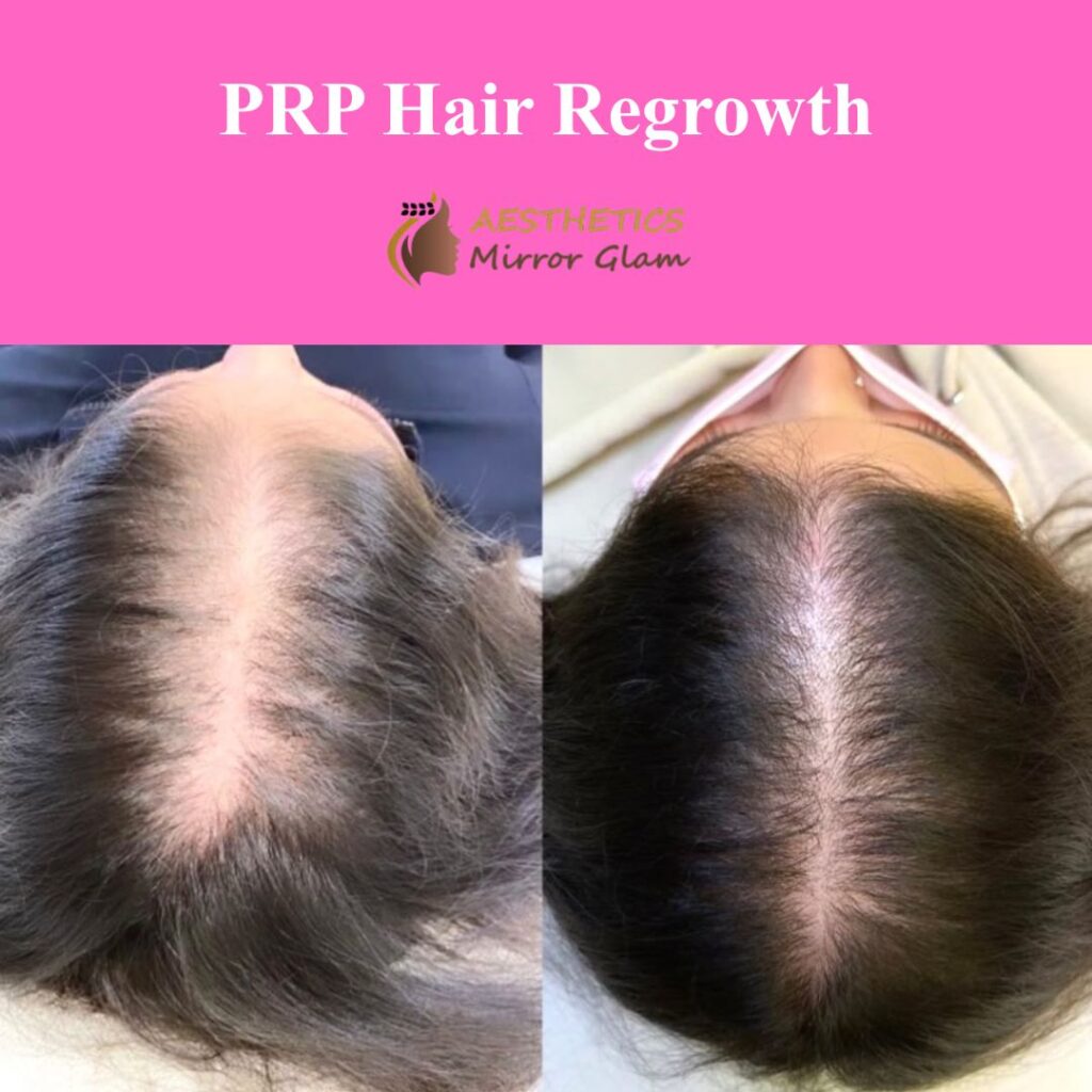 PRP Treatment for Hair & Face – The Ultimate Guide to Natural Rejuvenation