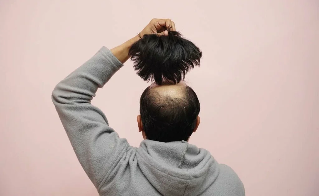 Wig Patch Hair replacement