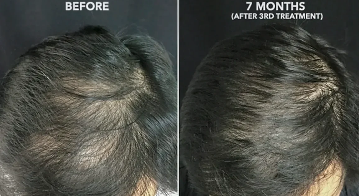 Platelet rich plasma treatment 1296x728 body 1296x728