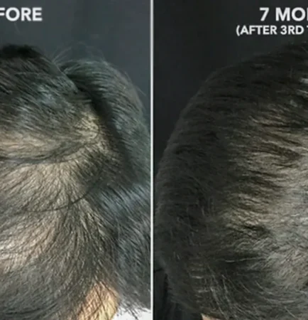 Platelet rich plasma treatment 1296x728 body 1296x728