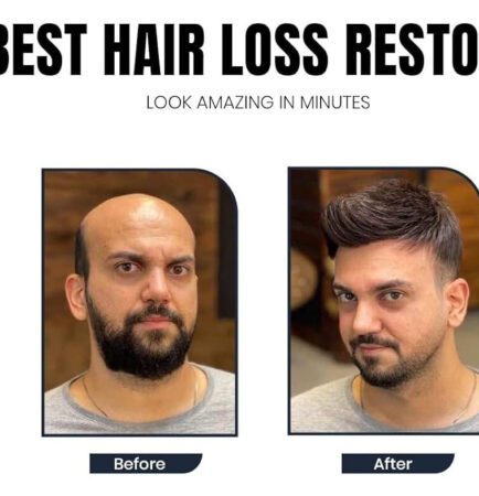Hair loss has become one of the most common problems among men and women today. Stressful lifestyles, pollution, hormonal imbalance, poor diet, and genetic factors are some of the major reasons behind excessive hair fall. Many people struggle with thinning hair, receding hairlines, and bald patches, which can affect confidence and overall appearance. If you are searching for the best hair loss treatment in Faridabad, professional clinics now offer advanced, non-surgical solutions that can effectively control hair fall and stimulate natural hair regrowth. At Aesthetics Mirror Glam Studio, Faridabad, experts provide modern and personalized hair restoration treatments designed to improve scalp health and promote strong, healthy hair growth. This detailed guide will help you understand the causes of hair loss, available treatments, benefits, and why choosing the right clinic is important. Understanding Hair Loss Hair loss is medically known as alopecia, and it occurs when hair follicles weaken or stop producing new hair. Losing around 50–100 strands daily is normal, but excessive hair shedding can indicate an underlying problem. Hair loss can affect both men and women and may appear in different forms such as: Gradual thinning on the scalp Receding hairline Bald patches Sudden hair shedding Weak and brittle hair Early diagnosis and proper treatment can help prevent permanent hair loss. Common Causes of Hair Loss 1. Genetic Hair Loss Genetic hair loss, also known as androgenetic alopecia, is one of the most common causes. It usually results in: Male pattern baldness Female pattern thinning This condition gradually weakens hair follicles over time. 2. Hormonal Imbalance Hormonal changes caused by: Pregnancy Thyroid disorders PCOS Menopause can lead to severe hair fall. 3. Stress and Lifestyle Modern lifestyle habits play a major role in hair damage. Factors include: Lack of sleep Work stress Poor diet Smoking and alcohol These factors weaken the hair growth cycle. 4. Nutritional Deficiency Hair requires essential nutrients such as: Iron Biotin Protein Zinc Vitamin D Deficiency of these nutrients can result in excessive hair fall. 5. Scalp Infections Dandruff, fungal infections, and scalp inflammation can damage hair follicles and cause hair thinning. Signs You Need Hair Loss Treatment Many people ignore early symptoms of hair loss until the problem becomes severe. Some warning signs include: Hair fall during combing or washing Widening hair parting Visible scalp Receding hairline Thinning ponytail Bald patches If you notice these symptoms, consulting a specialist is recommended. Advanced Hair Loss Treatments in Faridabad 4 Modern hair restoration treatments focus on stimulating hair follicles and improving scalp health without surgery. At Aesthetics Mirror Glam Studio Faridabad, several advanced techniques are used for effective results. 1. PRP Hair Treatment PRP (Platelet-Rich Plasma) therapy is one of the most popular non-surgical hair loss treatments. How PRP Works A small amount of blood is drawn from the patient. The blood is processed in a centrifuge to extract platelet-rich plasma. The PRP is injected into the scalp. Benefits Stimulates natural hair growth Strengthens weak hair follicles Reduces hair fall Improves hair density PRP treatment is safe and widely recommended by hair specialists. 2. Hair Growth Therapy Hair growth therapy combines scalp treatments, medical solutions, and advanced equipment to boost hair growth. Benefits Improves blood circulation in the scalp Nourishes hair roots Strengthens hair follicles Promotes thicker hair This therapy works well for people experiencing early-stage hair thinning. 3. Scalp Treatment A healthy scalp is essential for strong hair growth. Professional scalp treatments remove buildup, excess oil, and dandruff. Key Benefits Deep scalp cleansing Reduced dandruff Improved hair growth Balanced scalp health 4. Hair Patch or Non-Surgical Hair Replacement 4 For people with severe baldness, hair patch treatment offers an instant solution. A hair patch is a customized hair system attached to the scalp using medical-grade adhesives or clips. Advantages Immediate hair transformation Natural appearance Non-surgical solution Affordable alternative to hair transplant Hair patches are especially popular among men experiencing advanced baldness. Benefits of Professional Hair Loss Treatment Choosing professional treatment provides several advantages. 1. Accurate Diagnosis Hair specialists analyze scalp condition and determine the exact cause of hair loss. 2. Customized Treatment Plan Each patient receives a personalized solution based on their hair type and condition. 3. Safe and Effective Techniques Modern clinics use advanced technology and dermatologist-approved procedures. 4. Long-Term Results Professional treatments strengthen hair roots and improve long-term hair growth. Why Choose Aesthetics Mirror Glam Studio in Faridabad 4 If you are looking for the best hair loss treatment in Faridabad, Aesthetics Mirror Glam Studio provides advanced solutions for hair restoration. Key Highlights ✔ Experienced hair specialists ✔ Advanced PRP hair therapy ✔ Non-surgical hair replacement ✔ Personalized scalp treatments ✔ Hygienic and modern clinic environment The clinic focuses on providing safe and effective hair restoration treatments for both men and women. Hair Care Tips to Prevent Hair Loss In addition to professional treatments, following a healthy hair care routine can prevent hair fall. Maintain a Healthy Diet Include foods rich in: Protein Iron Biotin Omega-3 fatty acids Reduce Heat Styling Frequent use of straighteners and curling tools can weaken hair roots. Use Mild Hair Products Avoid harsh chemicals and choose sulfate-free shampoos. Manage Stress Yoga, meditation, and exercise help control stress-related hair fall. Regular Scalp Massage Scalp massage improves blood circulation and promotes hair growth. Who Should Consider Hair Loss Treatment Hair restoration treatments are suitable for: Men with receding hairlines Women with thinning hair Individuals experiencing excessive hair fall People with bald patches Patients with weak hair growth Early treatment ensures better and faster results. How Long Does Hair Loss Treatment Take Treatment duration varies depending on the condition. Typical timeline: PRP Therapy: 3–6 sessions Hair Growth Treatment: 2–4 months Scalp Therapy: Monthly sessions Hair Patch: Instant results Hair regrowth usually becomes noticeable within 3–4 months. Cost of Hair Loss Treatment in Faridabad The cost depends on factors such as: Type of treatment Number of sessions Hair loss severity Technology used Non-surgical treatments like PRP and scalp therapy are generally more affordable than hair transplant procedures. For accurate pricing, consultation with a specialist is recommended. Final Thoughts Hair loss can be distressing, but modern aesthetic treatments have made it possible to restore hair effectively without surgery. From PRP therapy and scalp treatments to non-surgical hair replacement systems, advanced techniques now provide safe and reliable solutions. If you are experiencing hair fall, early treatment can prevent further damage and promote healthy hair growth. For the best hair loss treatment in Faridabad, visit Aesthetics Mirror Glam Studio, where experts provide personalized hair restoration solutions using the latest technology. Regain your confidence and achieve stronger, healthier hair with professional hair care treatments designed for long-lasting results.