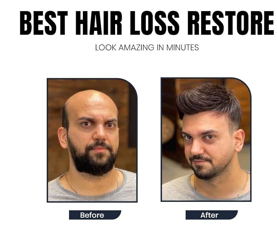 Hair loss has become one of the most common problems among men and women today. Stressful lifestyles, pollution, hormonal imbalance, poor diet, and genetic factors are some of the major reasons behind excessive hair fall. Many people struggle with thinning hair, receding hairlines, and bald patches, which can affect confidence and overall appearance. If you are searching for the best hair loss treatment in Faridabad, professional clinics now offer advanced, non-surgical solutions that can effectively control hair fall and stimulate natural hair regrowth. At Aesthetics Mirror Glam Studio, Faridabad, experts provide modern and personalized hair restoration treatments designed to improve scalp health and promote strong, healthy hair growth. This detailed guide will help you understand the causes of hair loss, available treatments, benefits, and why choosing the right clinic is important. Understanding Hair Loss Hair loss is medically known as alopecia, and it occurs when hair follicles weaken or stop producing new hair. Losing around 50–100 strands daily is normal, but excessive hair shedding can indicate an underlying problem. Hair loss can affect both men and women and may appear in different forms such as: Gradual thinning on the scalp Receding hairline Bald patches Sudden hair shedding Weak and brittle hair Early diagnosis and proper treatment can help prevent permanent hair loss. Common Causes of Hair Loss 1. Genetic Hair Loss Genetic hair loss, also known as androgenetic alopecia, is one of the most common causes. It usually results in: Male pattern baldness Female pattern thinning This condition gradually weakens hair follicles over time. 2. Hormonal Imbalance Hormonal changes caused by: Pregnancy Thyroid disorders PCOS Menopause can lead to severe hair fall. 3. Stress and Lifestyle Modern lifestyle habits play a major role in hair damage. Factors include: Lack of sleep Work stress Poor diet Smoking and alcohol These factors weaken the hair growth cycle. 4. Nutritional Deficiency Hair requires essential nutrients such as: Iron Biotin Protein Zinc Vitamin D Deficiency of these nutrients can result in excessive hair fall. 5. Scalp Infections Dandruff, fungal infections, and scalp inflammation can damage hair follicles and cause hair thinning. Signs You Need Hair Loss Treatment Many people ignore early symptoms of hair loss until the problem becomes severe. Some warning signs include: Hair fall during combing or washing Widening hair parting Visible scalp Receding hairline Thinning ponytail Bald patches If you notice these symptoms, consulting a specialist is recommended. Advanced Hair Loss Treatments in Faridabad 4 Modern hair restoration treatments focus on stimulating hair follicles and improving scalp health without surgery. At Aesthetics Mirror Glam Studio Faridabad, several advanced techniques are used for effective results. 1. PRP Hair Treatment PRP (Platelet-Rich Plasma) therapy is one of the most popular non-surgical hair loss treatments. How PRP Works A small amount of blood is drawn from the patient. The blood is processed in a centrifuge to extract platelet-rich plasma. The PRP is injected into the scalp. Benefits Stimulates natural hair growth Strengthens weak hair follicles Reduces hair fall Improves hair density PRP treatment is safe and widely recommended by hair specialists. 2. Hair Growth Therapy Hair growth therapy combines scalp treatments, medical solutions, and advanced equipment to boost hair growth. Benefits Improves blood circulation in the scalp Nourishes hair roots Strengthens hair follicles Promotes thicker hair This therapy works well for people experiencing early-stage hair thinning. 3. Scalp Treatment A healthy scalp is essential for strong hair growth. Professional scalp treatments remove buildup, excess oil, and dandruff. Key Benefits Deep scalp cleansing Reduced dandruff Improved hair growth Balanced scalp health 4. Hair Patch or Non-Surgical Hair Replacement 4 For people with severe baldness, hair patch treatment offers an instant solution. A hair patch is a customized hair system attached to the scalp using medical-grade adhesives or clips. Advantages Immediate hair transformation Natural appearance Non-surgical solution Affordable alternative to hair transplant Hair patches are especially popular among men experiencing advanced baldness. Benefits of Professional Hair Loss Treatment Choosing professional treatment provides several advantages. 1. Accurate Diagnosis Hair specialists analyze scalp condition and determine the exact cause of hair loss. 2. Customized Treatment Plan Each patient receives a personalized solution based on their hair type and condition. 3. Safe and Effective Techniques Modern clinics use advanced technology and dermatologist-approved procedures. 4. Long-Term Results Professional treatments strengthen hair roots and improve long-term hair growth. Why Choose Aesthetics Mirror Glam Studio in Faridabad 4 If you are looking for the best hair loss treatment in Faridabad, Aesthetics Mirror Glam Studio provides advanced solutions for hair restoration. Key Highlights ✔ Experienced hair specialists ✔ Advanced PRP hair therapy ✔ Non-surgical hair replacement ✔ Personalized scalp treatments ✔ Hygienic and modern clinic environment The clinic focuses on providing safe and effective hair restoration treatments for both men and women. Hair Care Tips to Prevent Hair Loss In addition to professional treatments, following a healthy hair care routine can prevent hair fall. Maintain a Healthy Diet Include foods rich in: Protein Iron Biotin Omega-3 fatty acids Reduce Heat Styling Frequent use of straighteners and curling tools can weaken hair roots. Use Mild Hair Products Avoid harsh chemicals and choose sulfate-free shampoos. Manage Stress Yoga, meditation, and exercise help control stress-related hair fall. Regular Scalp Massage Scalp massage improves blood circulation and promotes hair growth. Who Should Consider Hair Loss Treatment Hair restoration treatments are suitable for: Men with receding hairlines Women with thinning hair Individuals experiencing excessive hair fall People with bald patches Patients with weak hair growth Early treatment ensures better and faster results. How Long Does Hair Loss Treatment Take Treatment duration varies depending on the condition. Typical timeline: PRP Therapy: 3–6 sessions Hair Growth Treatment: 2–4 months Scalp Therapy: Monthly sessions Hair Patch: Instant results Hair regrowth usually becomes noticeable within 3–4 months. Cost of Hair Loss Treatment in Faridabad The cost depends on factors such as: Type of treatment Number of sessions Hair loss severity Technology used Non-surgical treatments like PRP and scalp therapy are generally more affordable than hair transplant procedures. For accurate pricing, consultation with a specialist is recommended. Final Thoughts Hair loss can be distressing, but modern aesthetic treatments have made it possible to restore hair effectively without surgery. From PRP therapy and scalp treatments to non-surgical hair replacement systems, advanced techniques now provide safe and reliable solutions. If you are experiencing hair fall, early treatment can prevent further damage and promote healthy hair growth. For the best hair loss treatment in Faridabad, visit Aesthetics Mirror Glam Studio, where experts provide personalized hair restoration solutions using the latest technology. Regain your confidence and achieve stronger, healthier hair with professional hair care treatments designed for long-lasting results.