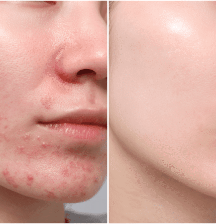 Acne Scar Treatment