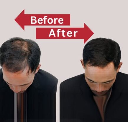 Best Hair Patch & Wig Treatment in Delhi NCR – Hair Replacement Solution
