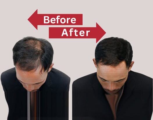 Best Hair Patch & Wig Treatment in Delhi NCR – Hair Replacement Solution