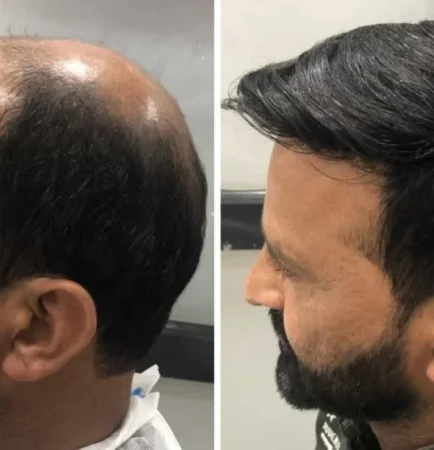 Best Hair Patch & Wig Treatment in Delhi – Modern Hair Replacement Solution