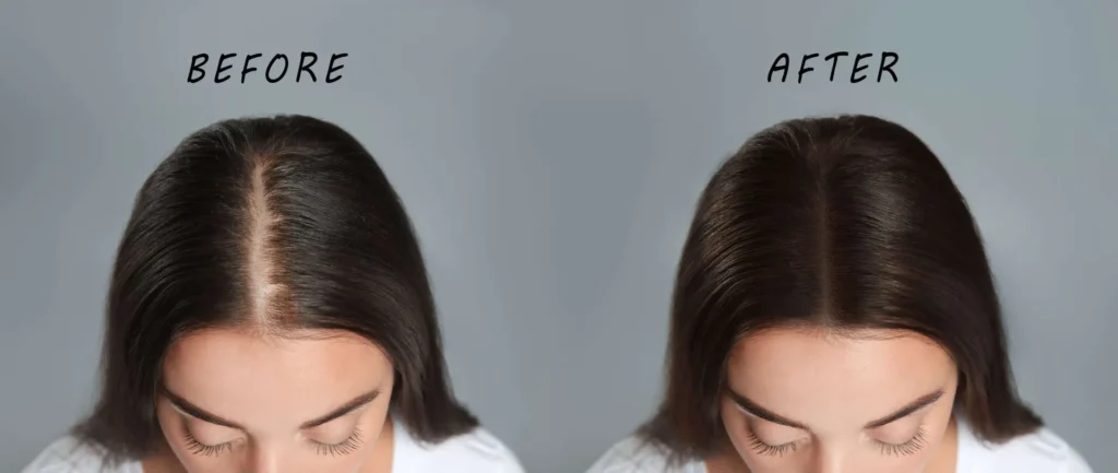 Hair Loss Treatment in Delhi – Causes, Solutions & Advanced Hair Regrowth