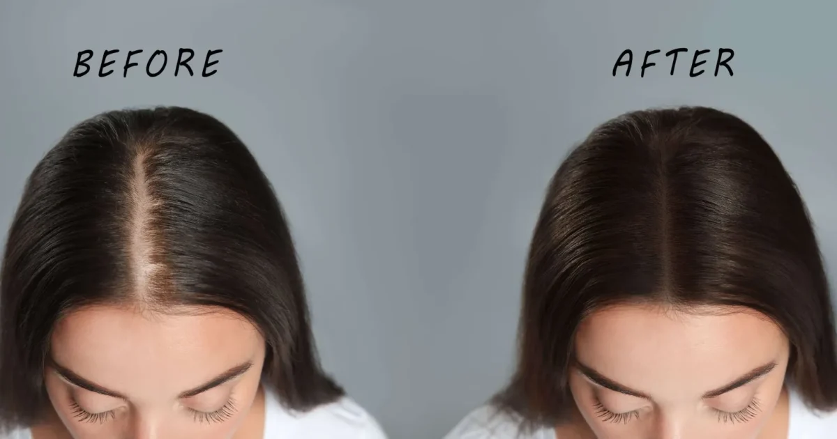 Hair Loss Treatment in Delhi – Causes, Solutions & Advanced Hair Regrowth