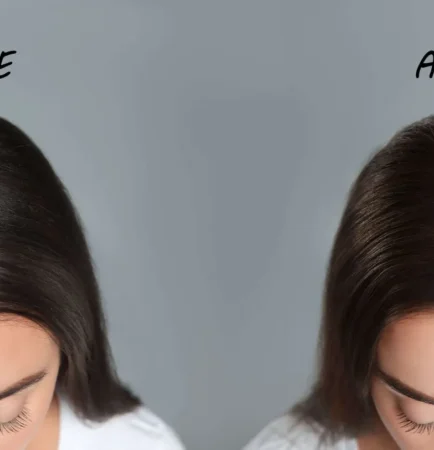 Hair Loss Treatment in Delhi – Causes, Solutions & Advanced Hair Regrowth