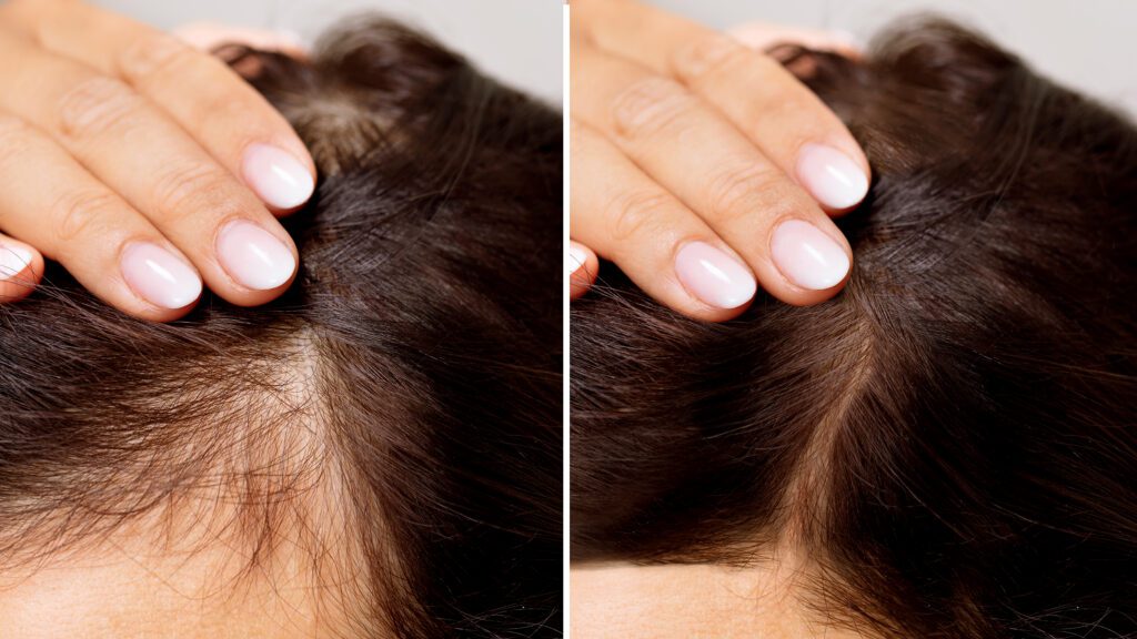 Before And After Hair Loss Treatment