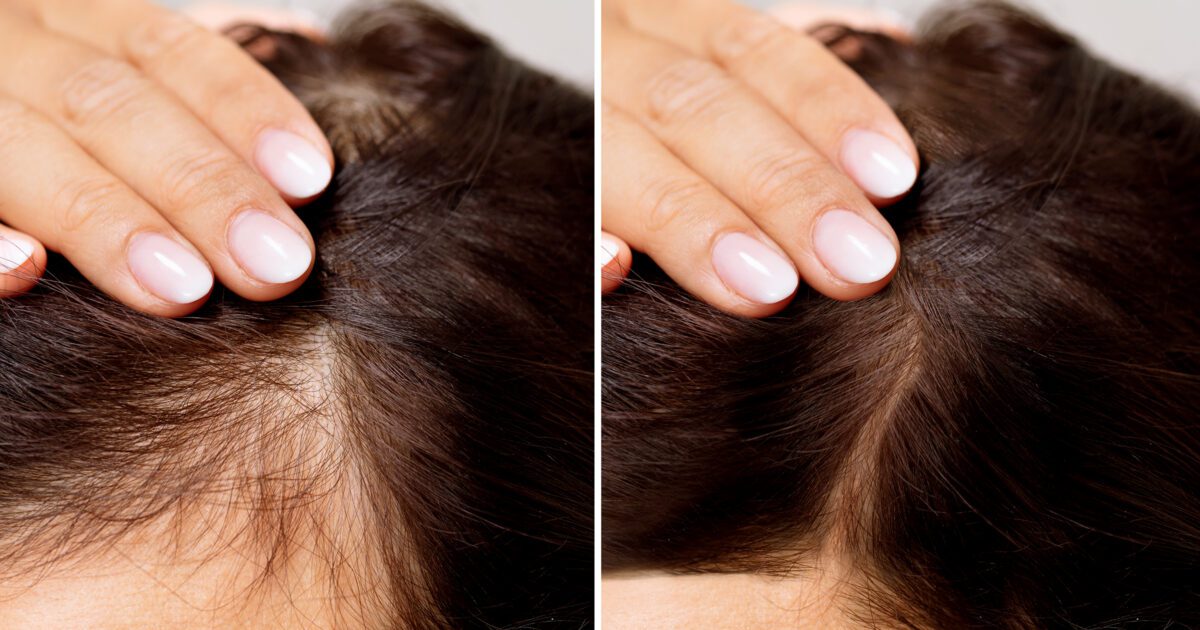 Before And After Hair Loss Treatment