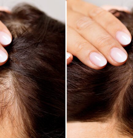 Before And After Hair Loss Treatment