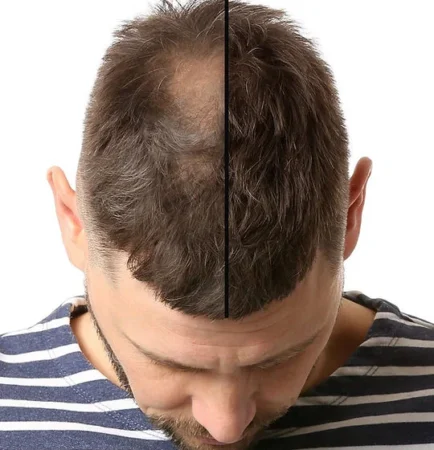 Hair Patch & Wig Treatment – Advanced Hair Replacement