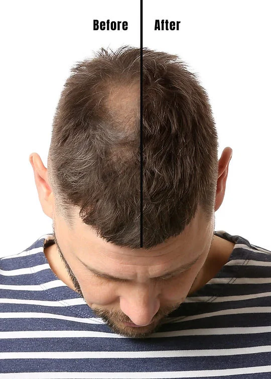 Hair Patch & Wig Treatment – Advanced Hair Replacement