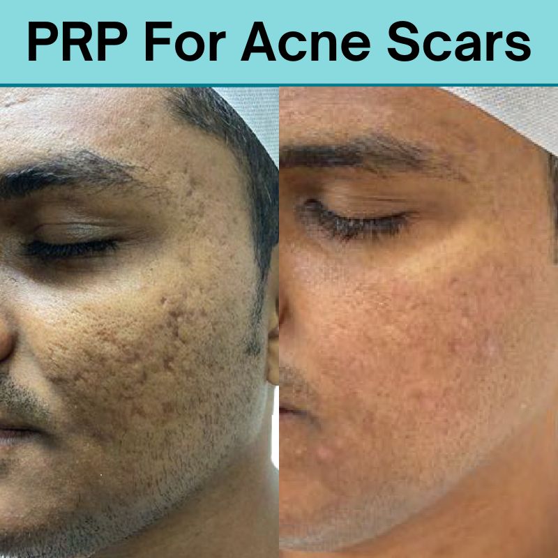https://media.olivaclinic.com/website-media/2025/02/PRP-For-Acne-Scars.jpg