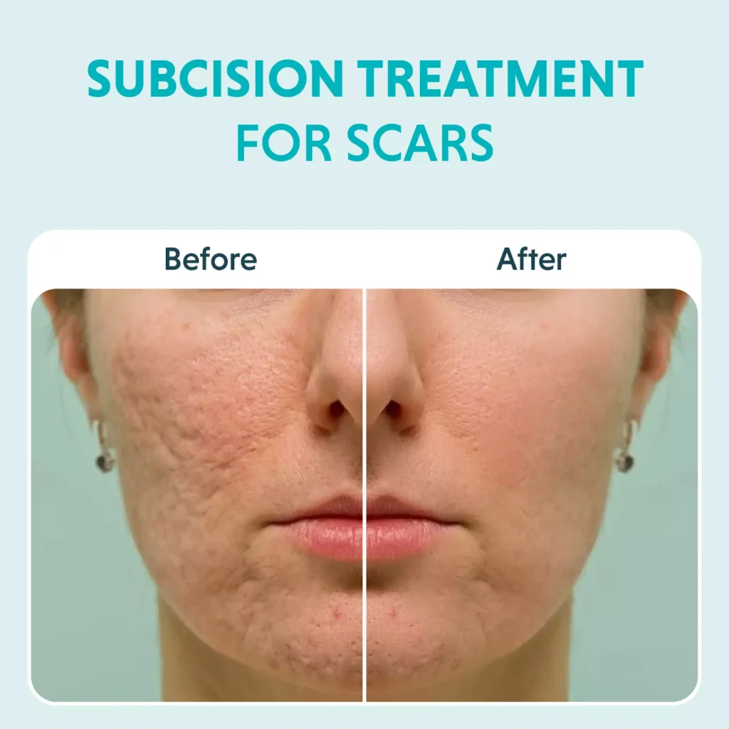 https://media.olivaclinic.com/website-media/2024/06/Subcision-Treatment-For-Acne-Scars.jpg.webp