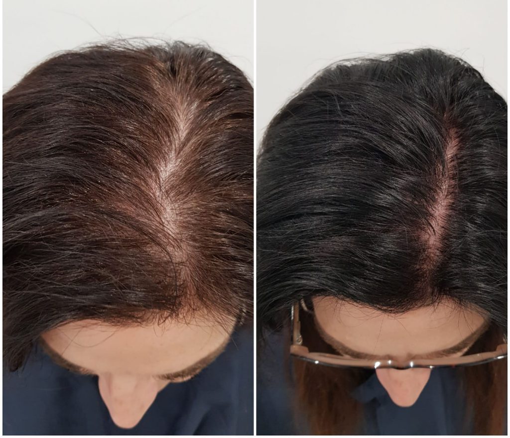 Before and after female