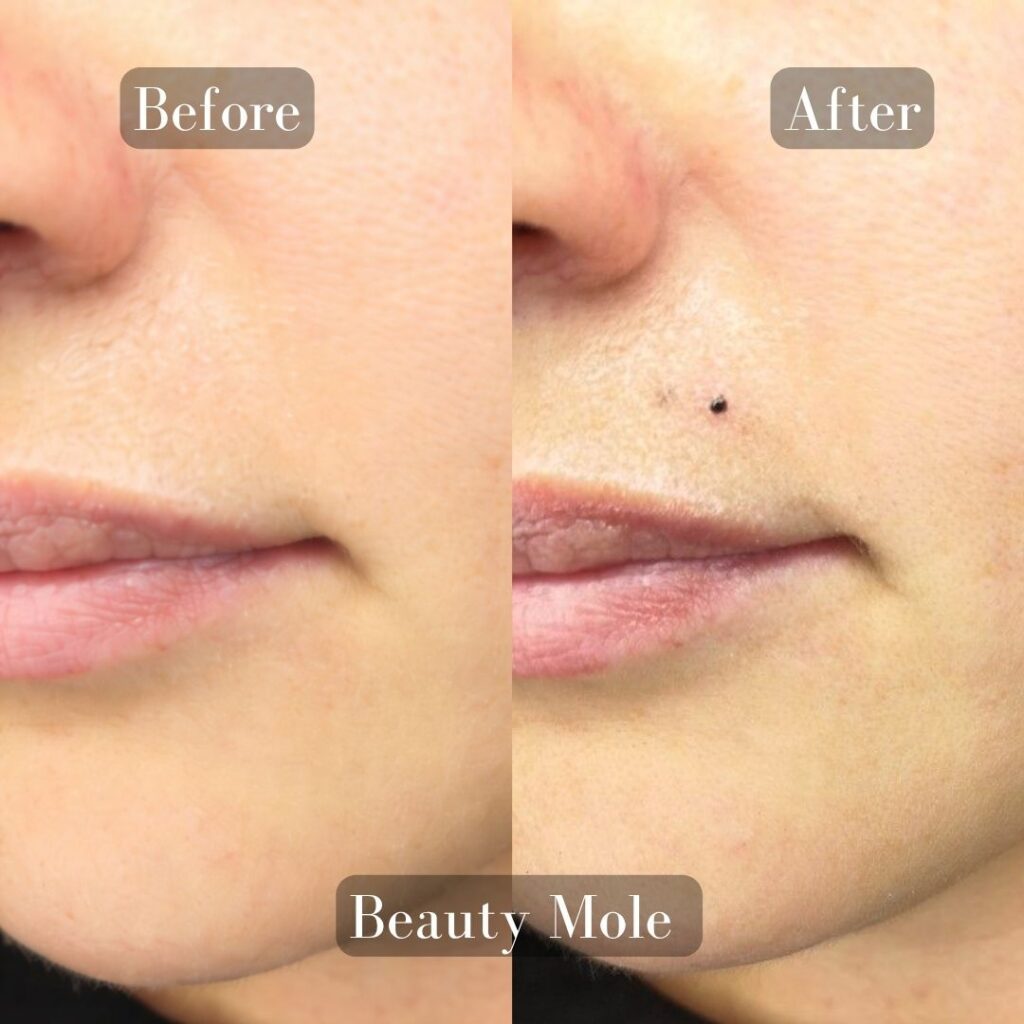 Beauty mole PMU near me, beauty mole PMU in rohini