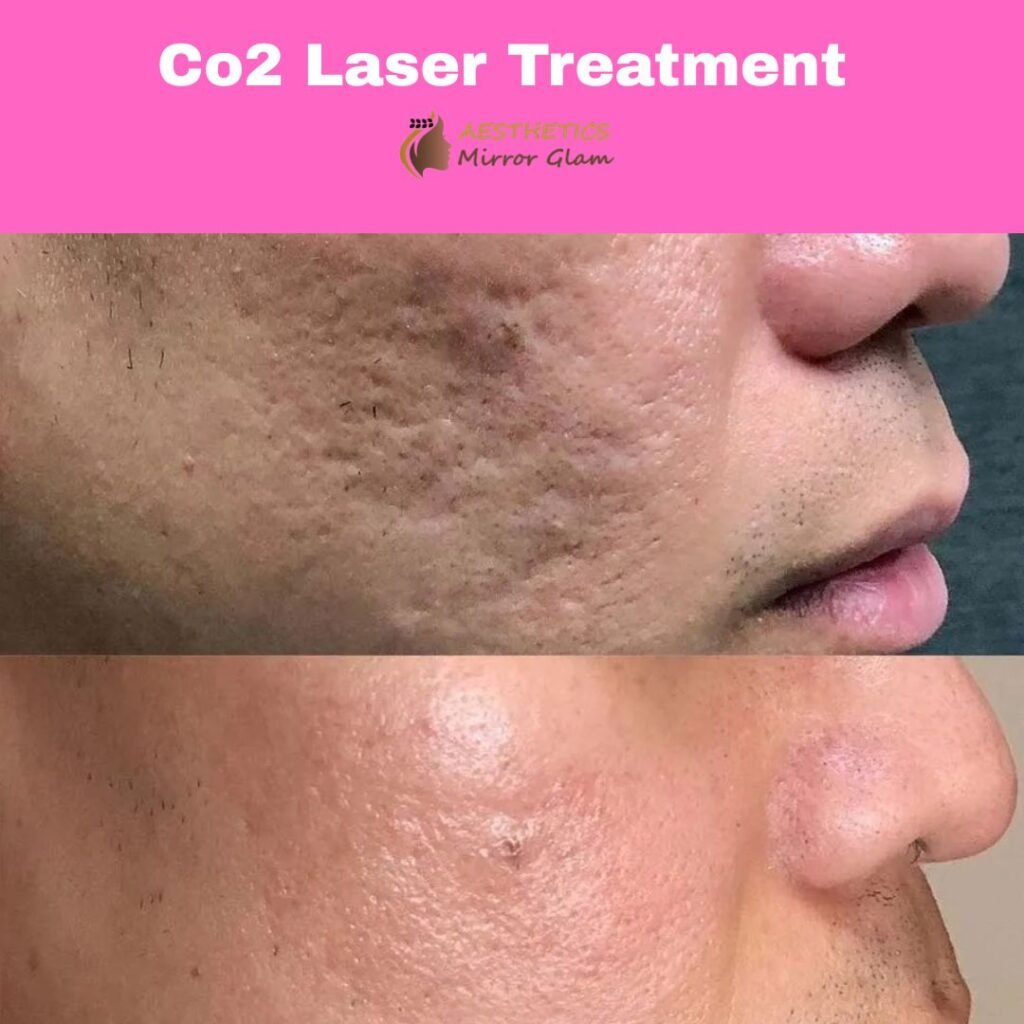 CO2 laser acne scar treatment in Rohini