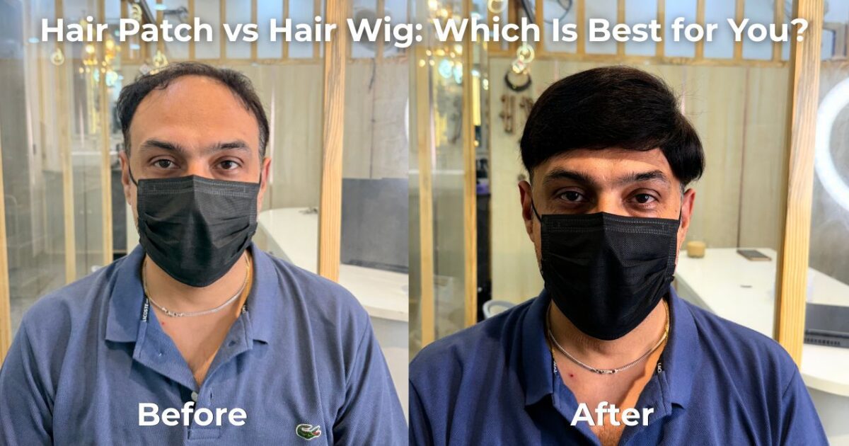 Hair Patch vs Hair Wig Which Is Best for You