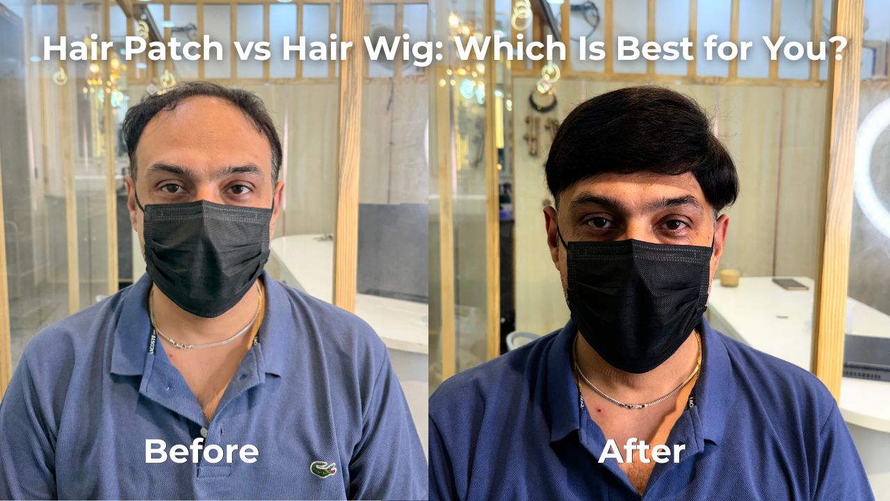 Hair Patch vs Hair Wig Which Is Best for You