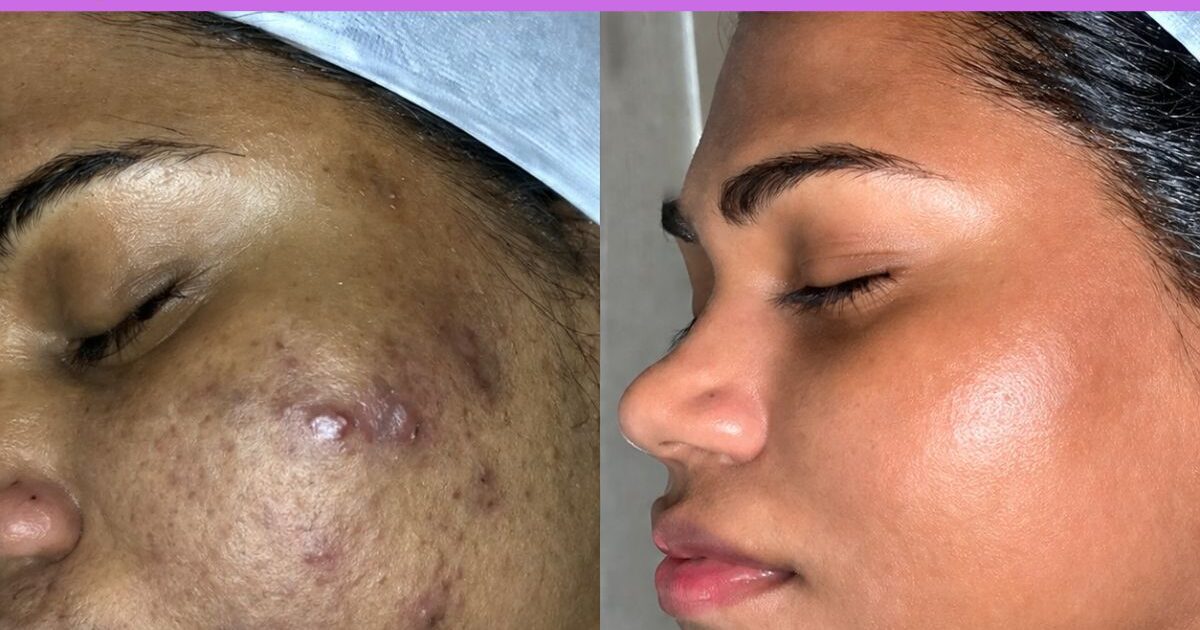 Chemical peel, chemicalpeel near me, chemical peel before & after