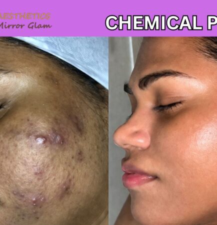 Chemical peel, chemicalpeel near me, chemical peel before & after