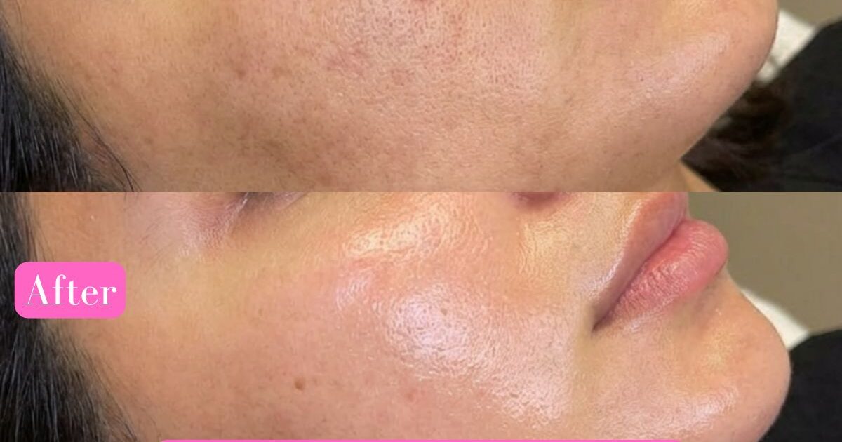 Korean Glass Skin Treatment in Delhi
