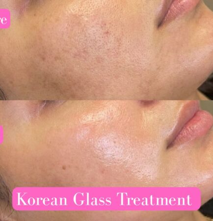 Korean Glass Skin Treatment in Delhi