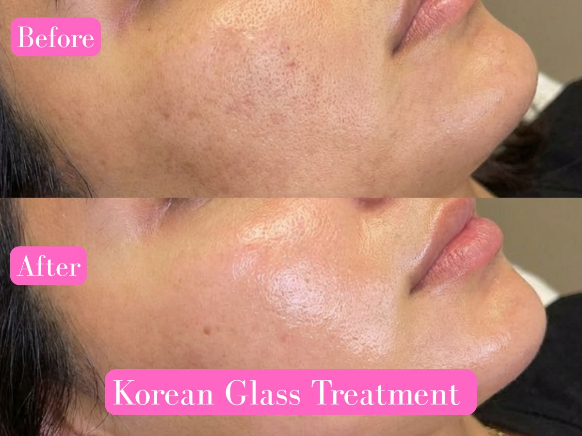 Korean Glass Skin Treatment in Delhi
