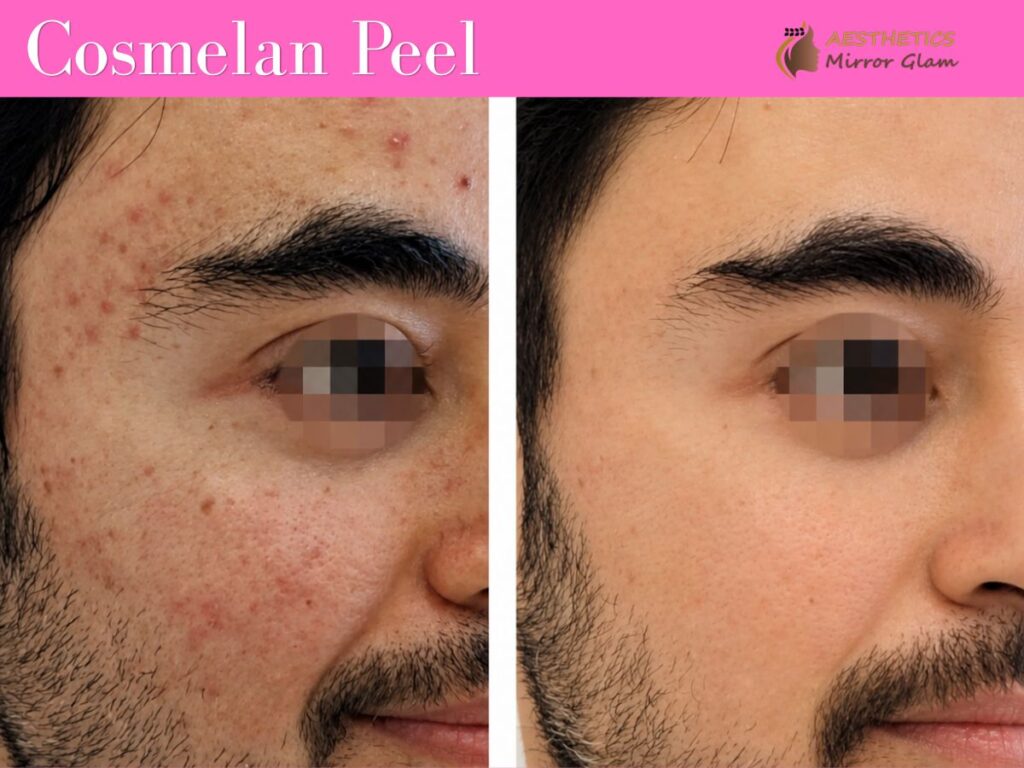 Best Cosmelan Peel treatment in rohini, delhi
