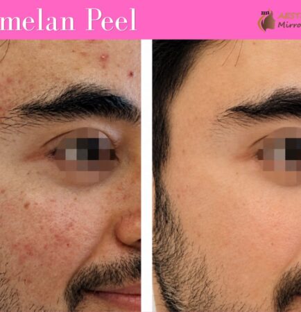 Best Cosmelan Peel treatment in rohini, delhi