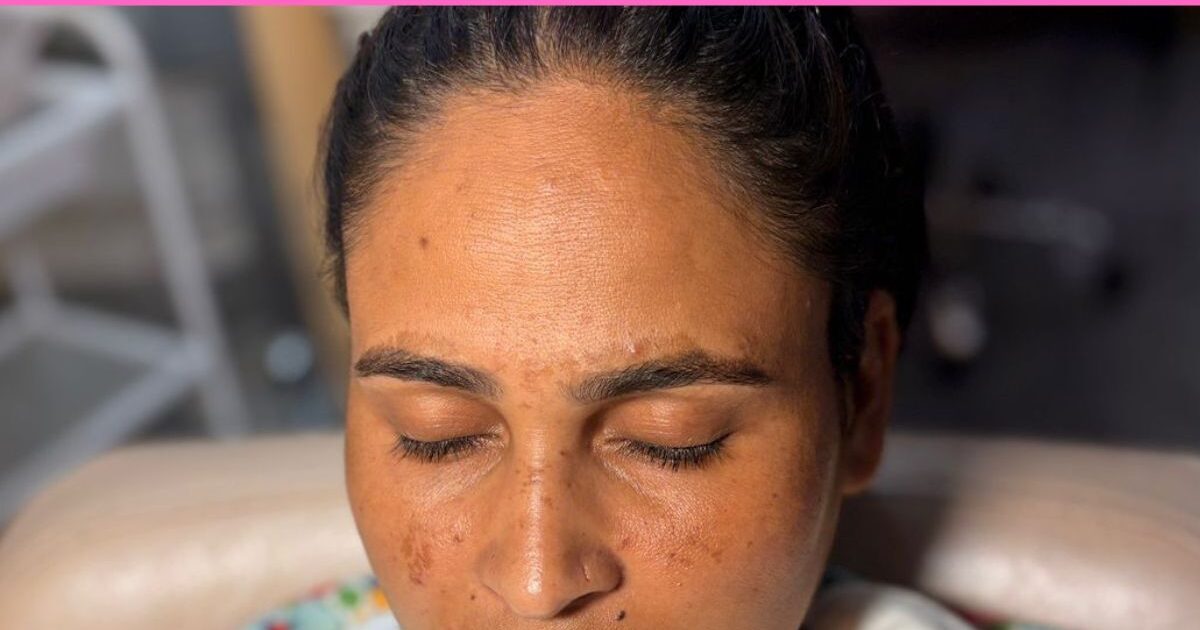 Collagen treatment for pigmentation removal