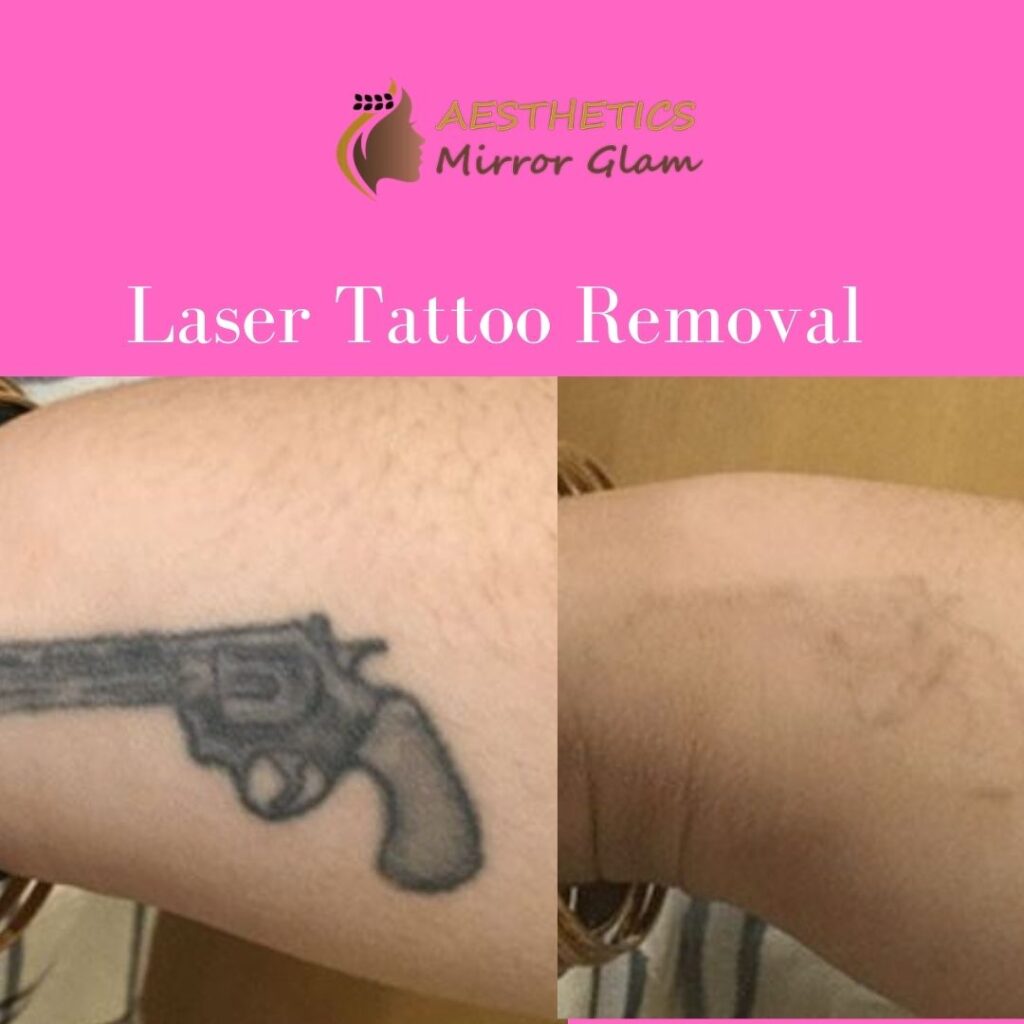 Laser tattoo removal coast in rohini delhi.