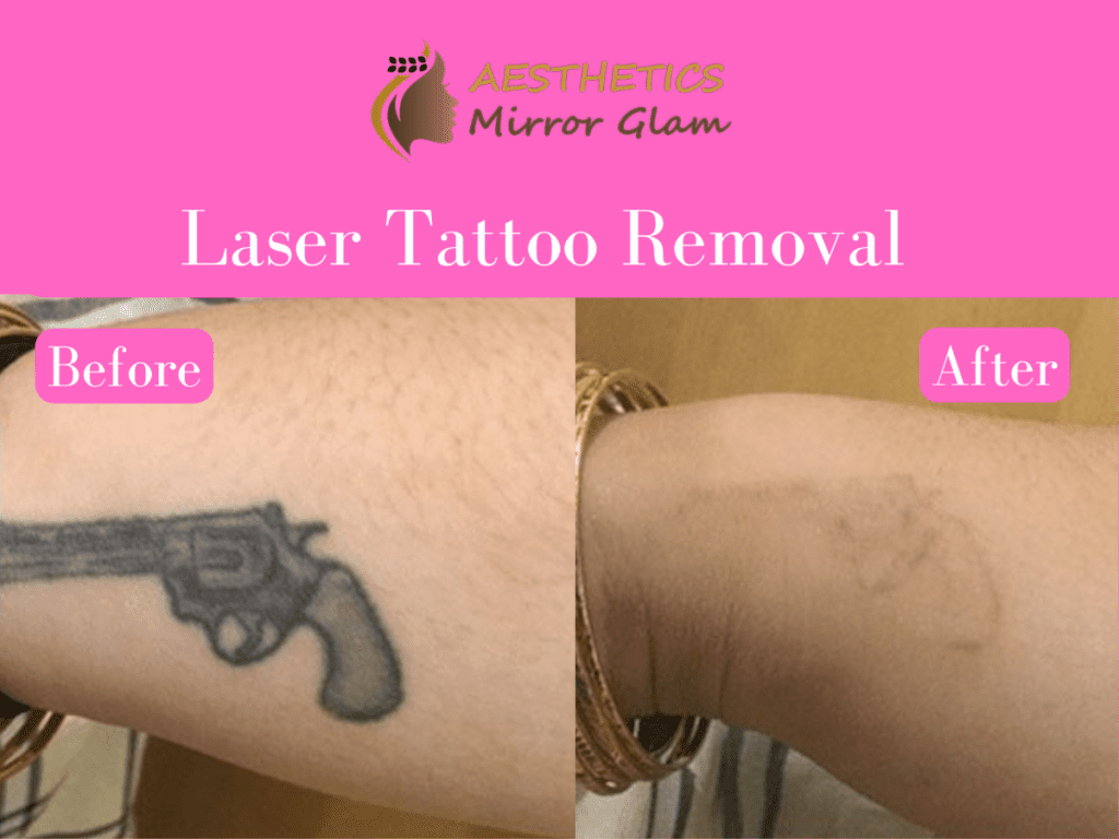 Laser tattoo removal cost rohini, delhi