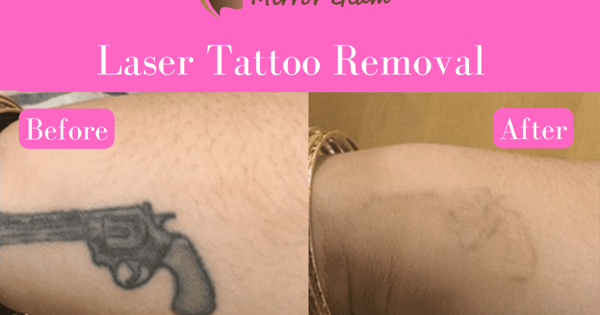 Laser tattoo removal cost rohini, delhi