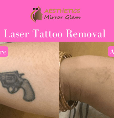 Laser tattoo removal cost rohini, delhi