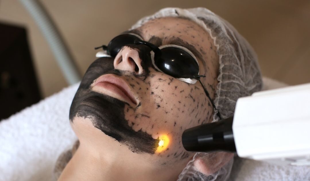 Carbon peel Laser tonning near me, carbon facial in rohini delhi