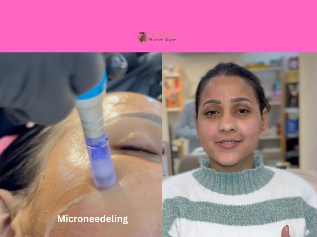 Microneedeling (1)