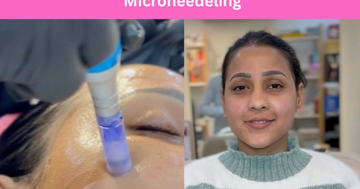 Microneedeling rohini delhi skin tightening
