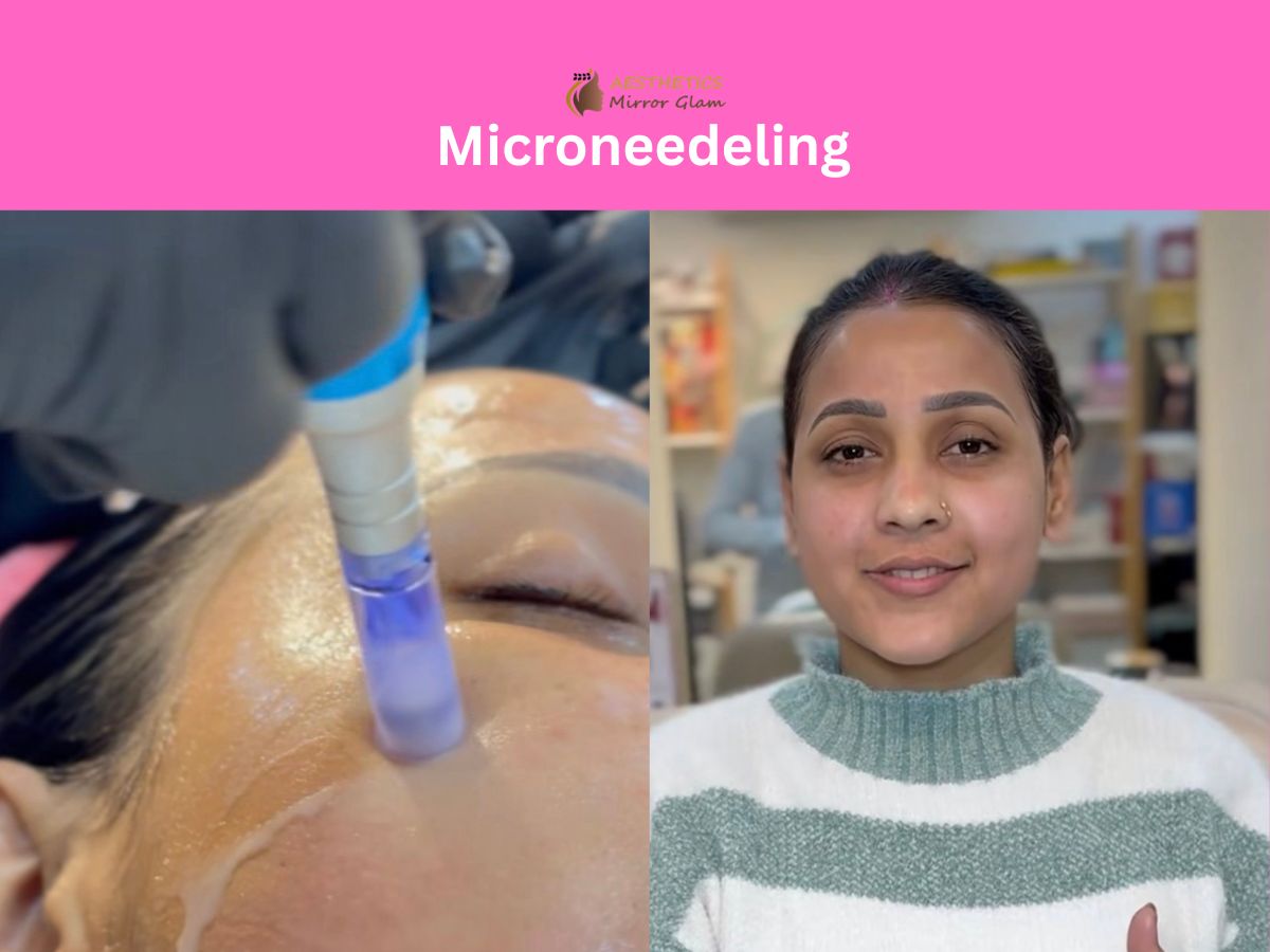 Microneedeling rohini delhi skin tightening