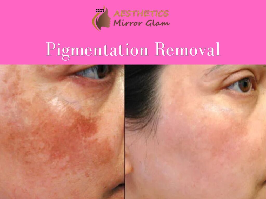 Pigmentation removal near me